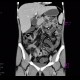 Crohn's disease of ileum, CT enterocysis, 2009: CT - Computed tomography